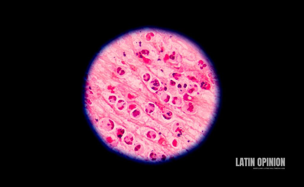 ciclosporiasis