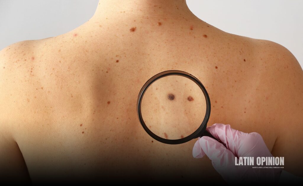 melanoma